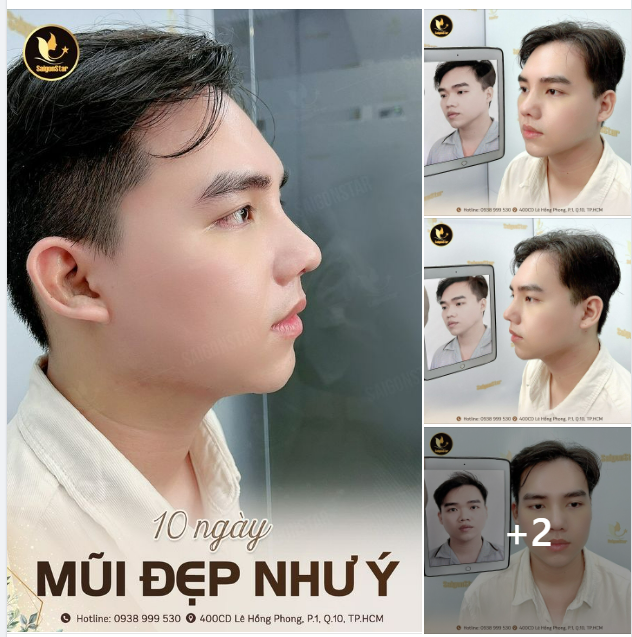 10 NGÀY MŨI ĐẸP NHƯ Ý
