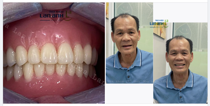 Hình ảnh 1 ca phục hình 2 hàm tháo lắp do Bác sĩ Thuỷ- chi nhánh 292 thực hiện.
