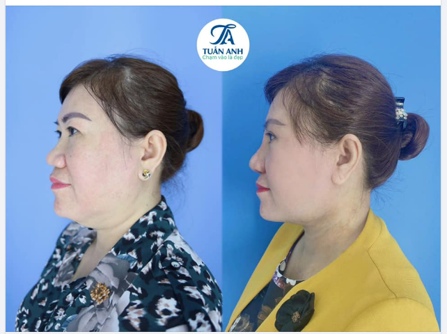 "CHỊ/EM GẦY NHƯNG VẪN CÓ MỠ NỌNG CẰM…"