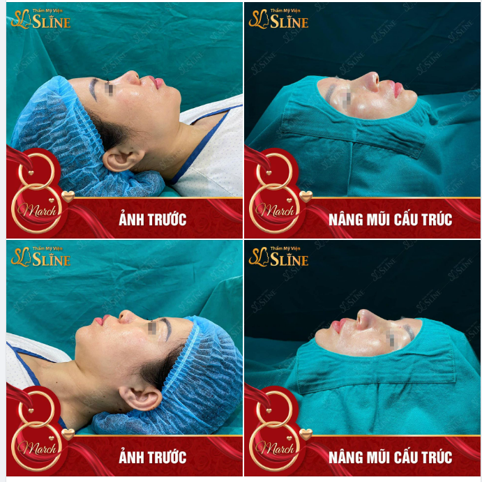 THAY ĐỔI RÕ RỆT CỦA KHÁCH HÀNG TRƯỚC VÀ SAU KHI NÂNG MŨI.