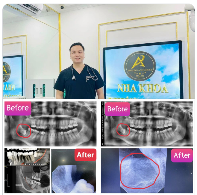 NHỔ RĂNG KHÔN KHÔNG ĐAU - AN TOÀN - NHANH CHÓNG!
