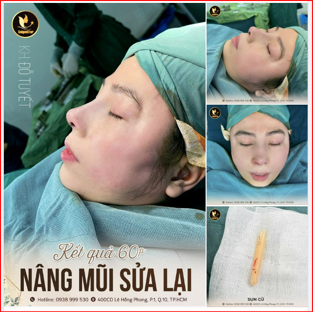 KẾT QUẢ SAU 60 PHÚT NÂNG MŨI SỬA LẠI