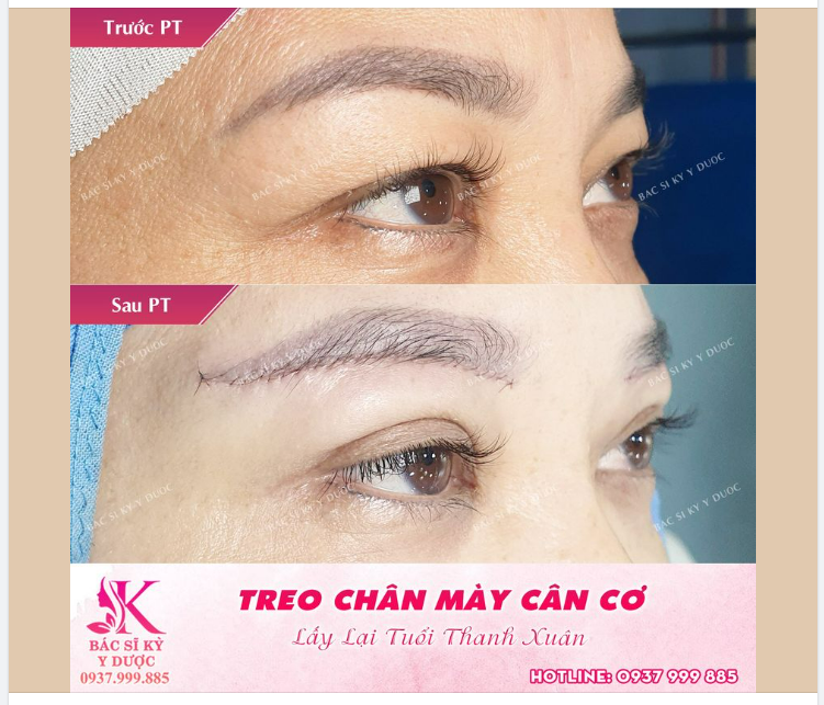 TREO CUNG CHÂN MÀY - GIẢI PHÁP TỐT NHẤT CHO TÌNH TRẠNG SỤP MÍ