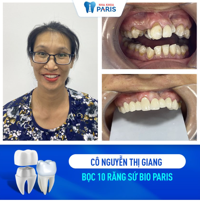 Một case phục hình răng sứ đại thành công cho cô Nguyễn Thị Giang đến từ Quảng Ninh!