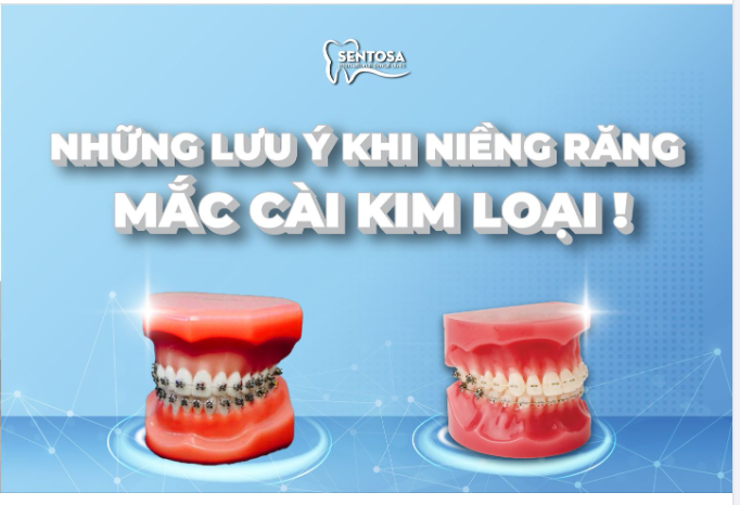 NHỮNG LƯU Ý KHI NIỀNG RĂNG MẮC CÀI KIM LOẠI