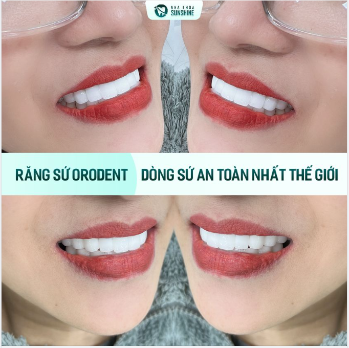 SỞ HỮU NỤ CƯỜI CHUẨN ĐẸP TỰ NHIÊN với dòng sứ AN TOÀN NHẤT THẾ GIỚI