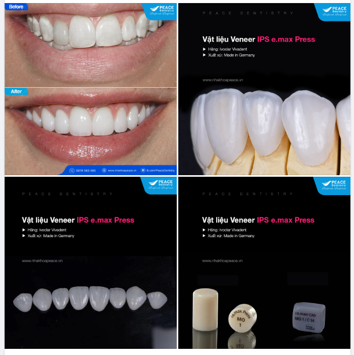 Mặt dán sứ Veneer IPS e.Max Press: Lựa chọn hàng đầu tại Peace Dentistry cho sự hoàn mỹ