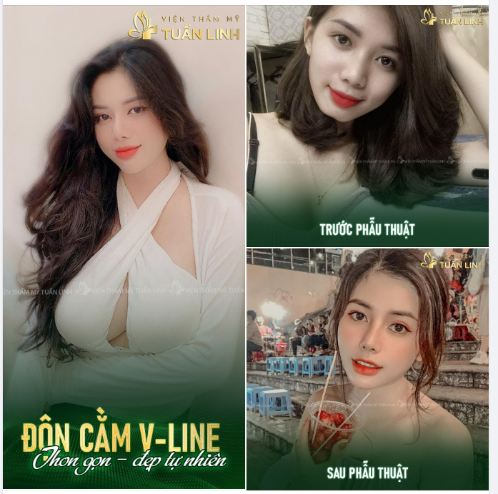 Cằm ngắn, cằm vuông, cằm chẻ  Độn cằm Vline để có khuôn mặt xinh sang, trẻ đẹp, cân đối và hài hòa như bạn khách hàng này nha!