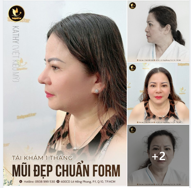 SAU 1 THÁNG NÂNG MŨI – MŨI ĐẸP CHUẨN AN TOÀN