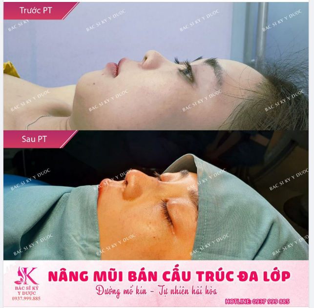 Oh-h-h, sự chú ý của ta lỡ va phải vào chiếc mũi của nàng