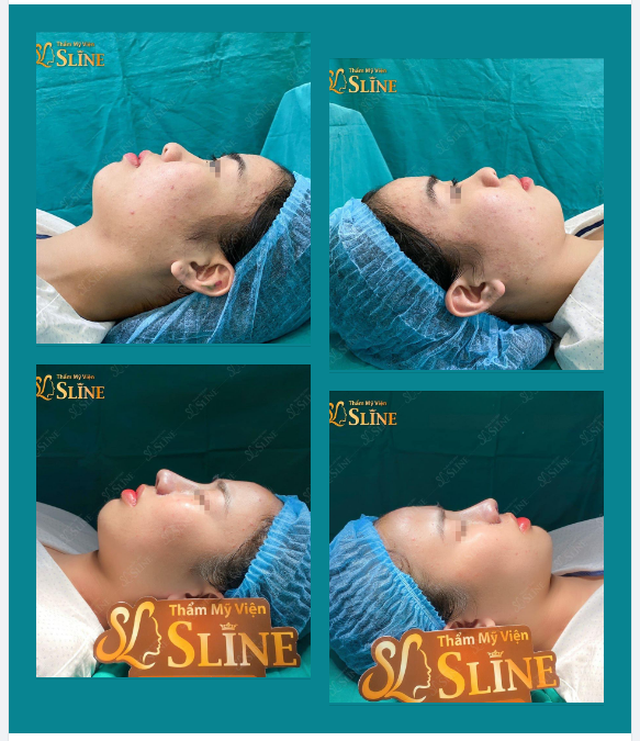 NÂNG MŨI CẤU TRÚC  NÂNG TẦM NHAN SẮC.