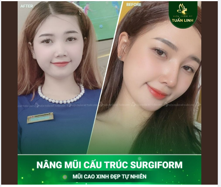 Nếu bạn thích một chiếc mũi cao tự nhiên thì tham khảo ngay dáng mũi này nhà Tuấn Linh nha!!