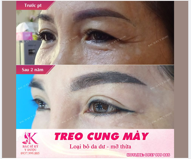 Treo Cung Chân Mày - Tìm Lại Tuổi Xuân