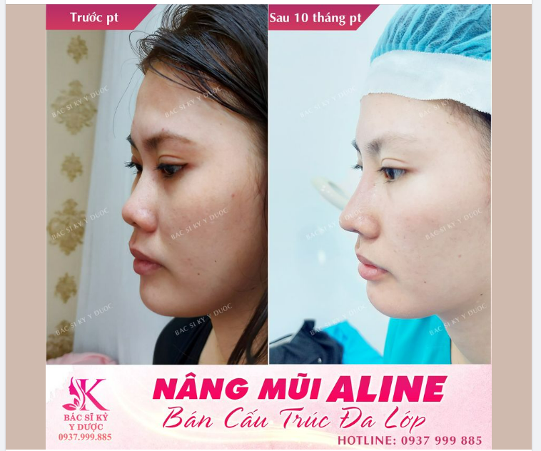 TẠM BIỆT MŨI THẤP - ĐÓN MŨI CAO SANG