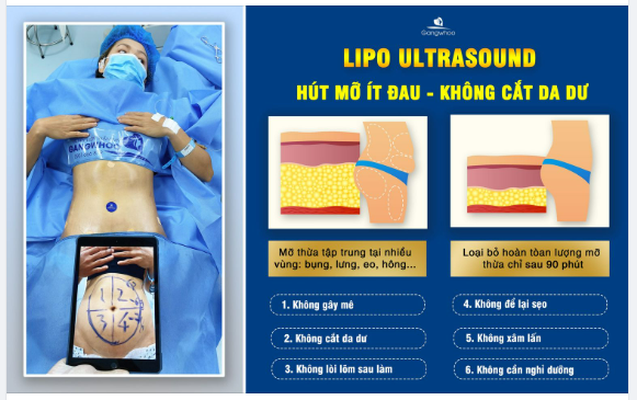 HÚT MỠ ÍT ĐAU GỌI TÊN CÔNG NGHỆ LIPO ULTRASOUND