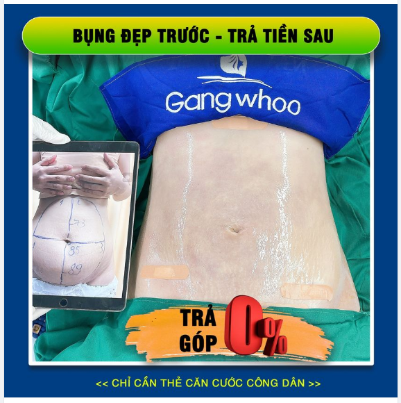 BỤNG ĐẸP TRƯỚC - TIỀN TRẢ SAU - LÀM 2 TÍNH TIỀN 1