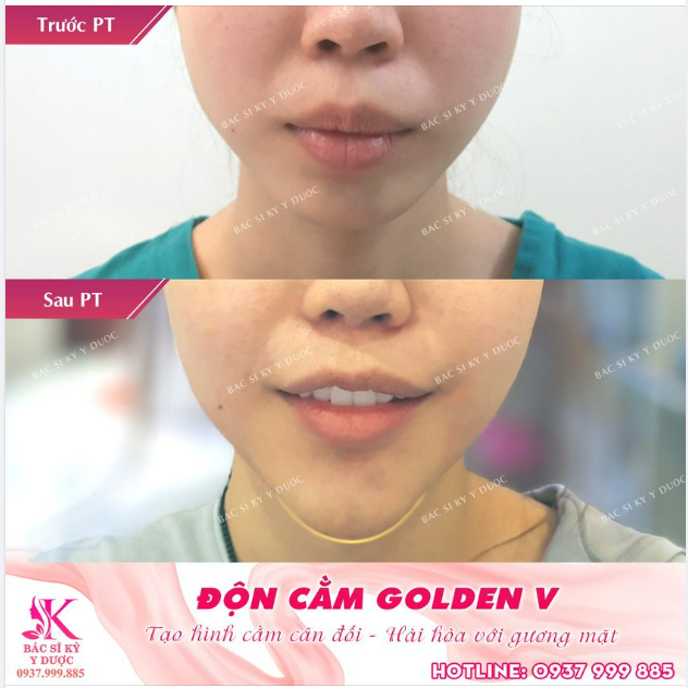 Một trường hợp hàm hô nhẹ được khắc phục thành công với Phẫu thuật Độn cằm GOLDEN V