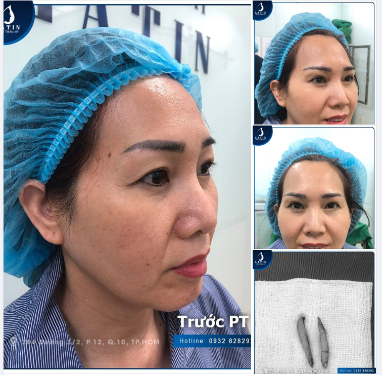 Với những chị em đã có nếp mí sẵn nhưng bị sụp mí, nhiều da dư, mỡ thừa kéo chân mày xuống, bác sĩ tại Latin sẽ chỉ định phương pháp: