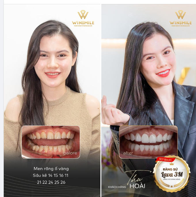 "CHỐT ĐƠN" RĂNG SỨ CHỈ TRONG 5 PHÚT VÌ GẶP ĐƯỢC ĐÚNG CHUYÊN GIA