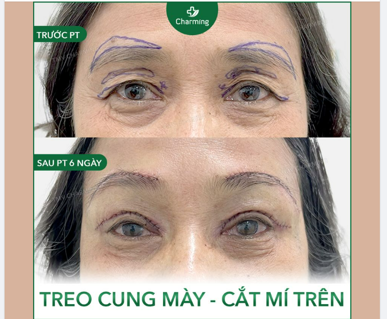 Thông thường mọi người hay phân vân không biết nên nâng cung mày hay cắt mí mà quên rằng có một số trường hợp cần sự phối hợp của cả hai phẫu thuật treo cung mày và cắt mí.