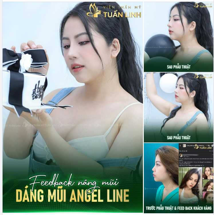 Dáng mũi Angel Line độc quyền tại Tuấn Linh sau 2 năm!