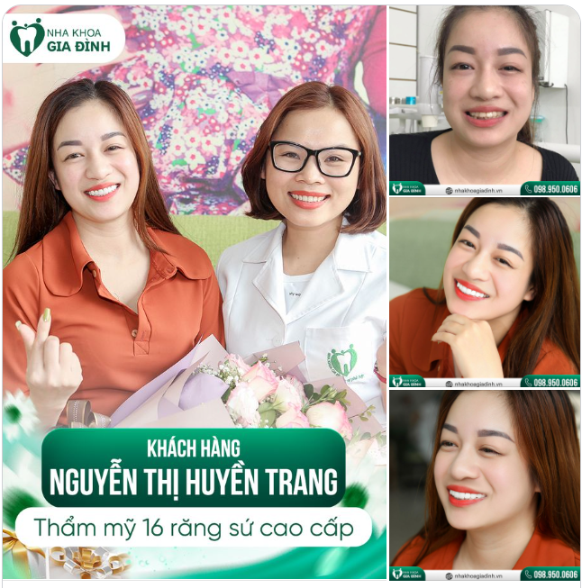 THẨM MỸ RĂNG SỨ - ĐIỂM TÔ CHO NỤ CƯỜI THÊM PHẦN DUYÊN DÁNG