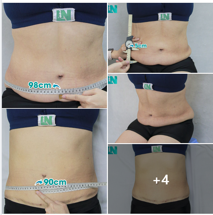  HÚT MỠ TẠO DÁNG THẨM MỸ KẾT HỢP  CẤY MỠ TẠO DÁNG V.3 CHO CHỊ KH 7X