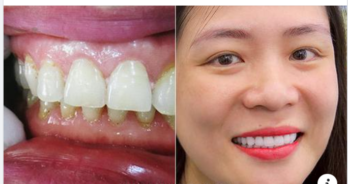 Vì Sao Viền Nướu Bị Đen Sau Khi Bọc Răng Sứ?