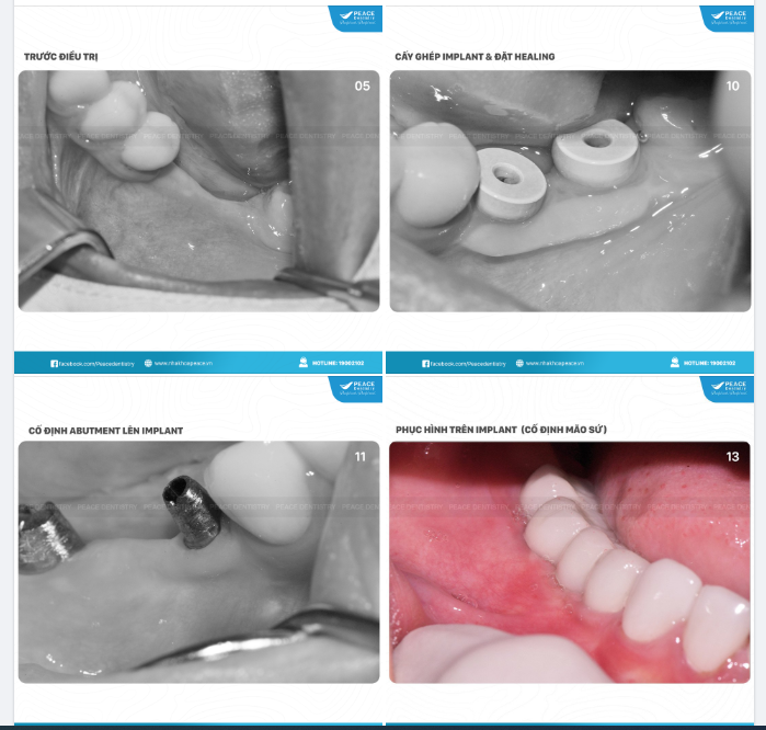 Cận cảnh sau khi cấy ghép trụ Implant và phục hình răng sứ cho thấy những giá trị ưu việt mà "răng Implant" mang lại