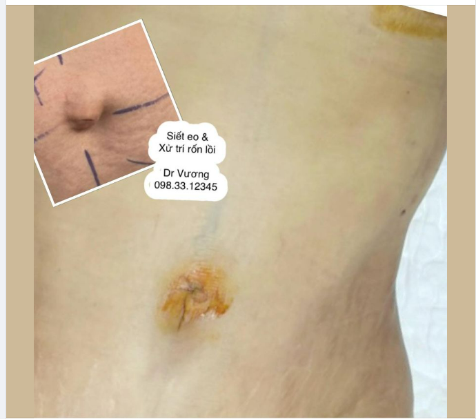 Tạo hình chỉnh sửa rốn với Dr Vương