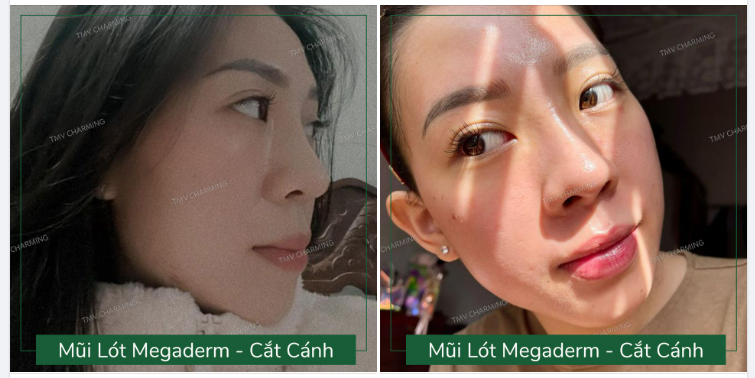 Mặc dù Bs Khanh vẫn có nâng mũi bằng megaderm nhưng bác lại rất hạn chế sử dụng phương pháp này bởi không phải ai cũng phù hợp để nâng mũi lót sụn bằng megaderm.