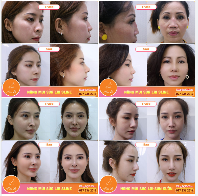 Khách hàng sửa thành công mũi hỏng để lại hình ảnh Feedback siêu ấn tượng cho Hiệp Lợi