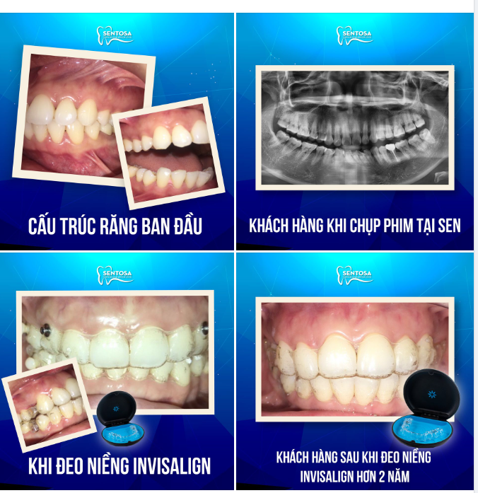 Bổ quả cau ra thấy Feedback Invisalign, đúng nhận sai đến SEN nào!!!