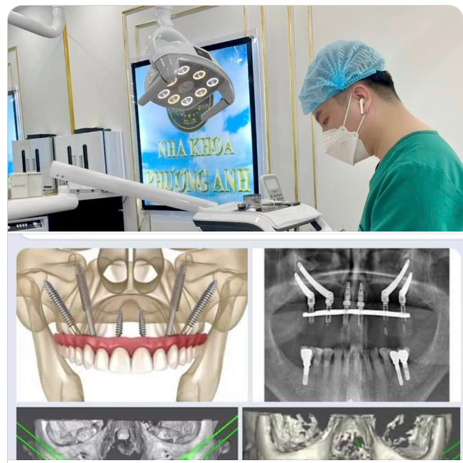 RĂNG IMPLANT LÀM TỪ CHẤT LIỆU GÌ?