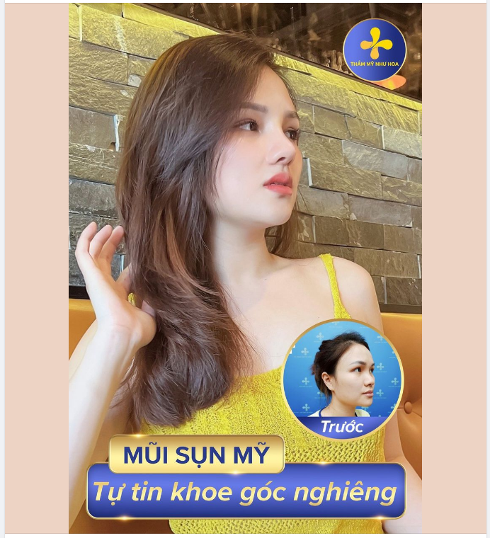 Nâng mũi thay đổi khuôn mặt, thần thái của một người! Chỉ cần một vài thay đổi nhỏ trên chiếc mũi, bạn gái đã “lột xác” hoàn toàn với nhan sắc nổi bật, xinh đẹp, sang chảnh.