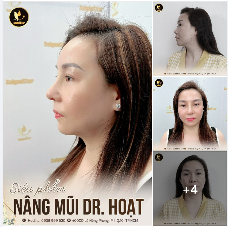 SIÊU PHẨM NÂNG MŨI DR. HOẠT