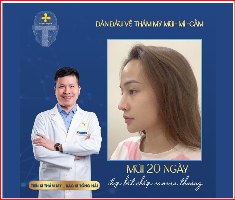NÂNG MŨI ​​​​​​​20 NGÀY - ĐẸP BẤT CHẤP CAMERA THƯỜNG
