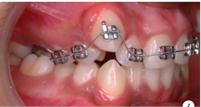 Răng mọc lệch xử lý cách nào?