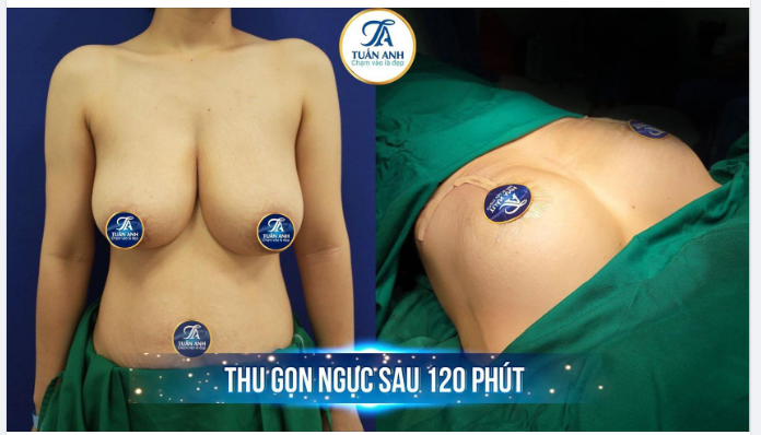 Không cần phải mang "2 quả tạ" trên người nữa, cột sống cổ và lưng cũng không còn chịu ảnh hưởng nặng nề