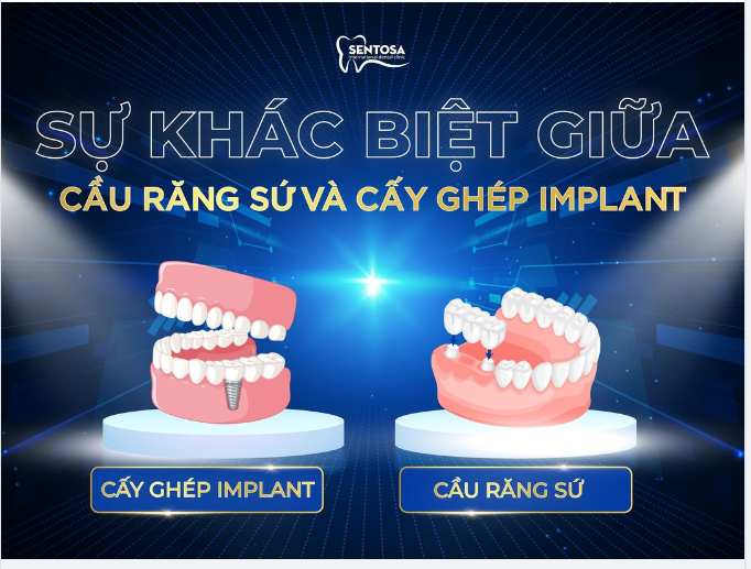 SO SÁNH SỰ KHÁC BIỆT GIỮA CẦU RĂNG SỨ VÀ CẤY GHÉP IMPLANT