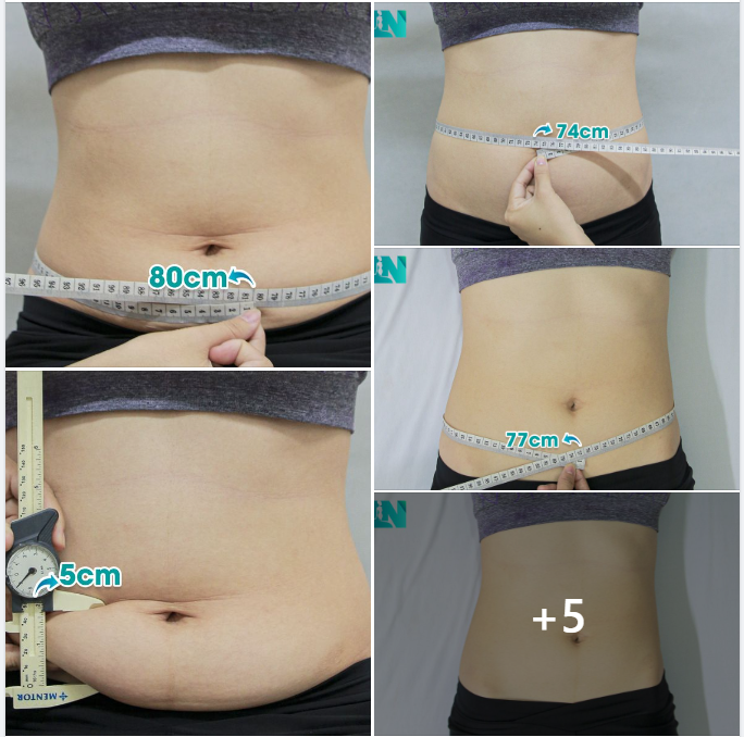 TÌM LẠI DÁNG VÓC CHO CHỊ KH SAU SINH, TIN TƯỞNG EKIP VÌ ĐƯỢC NGƯỜI QUEN GIỚI THIỆU. 