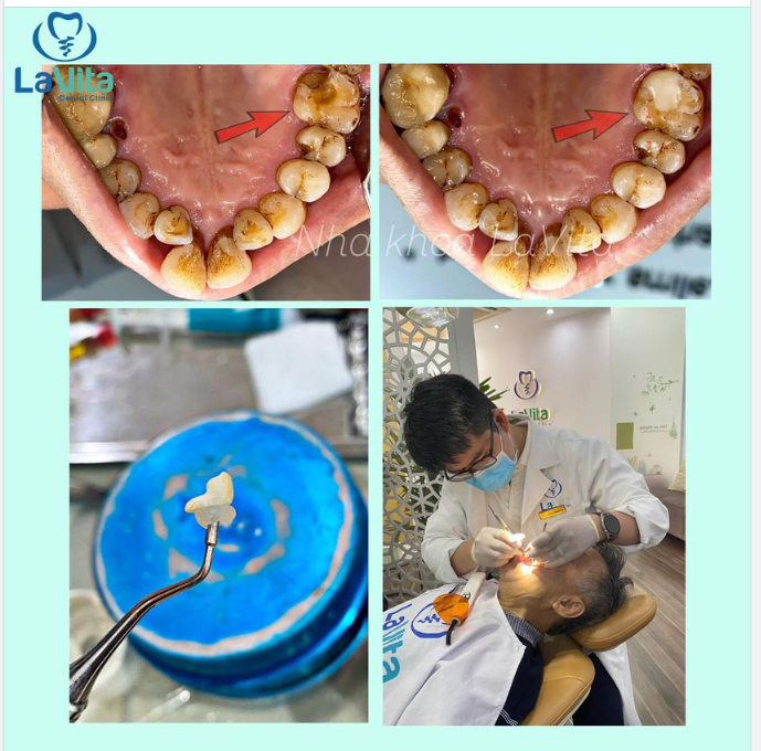 Bác khách hàng ngày hôm nay đến với Nha khoa Lavita trong tình trạng răng hàm trên bị vỡ lớn, thường xuyên giắt thức ăn gây cảm giác vô cùng khó chịu.