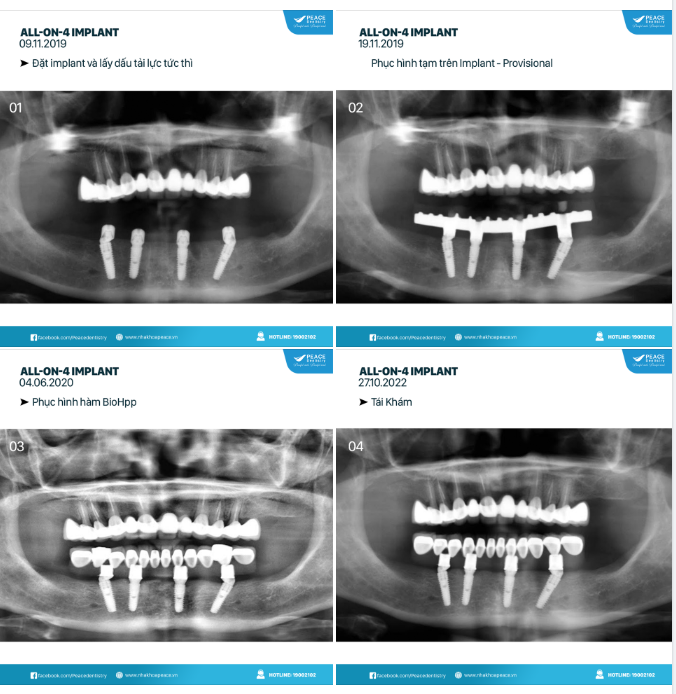 Các hình ảnh theo thời gian của một ca lâm sàng  All on 4 Implant (Implant toàn hàm) tại Peace Dentistry