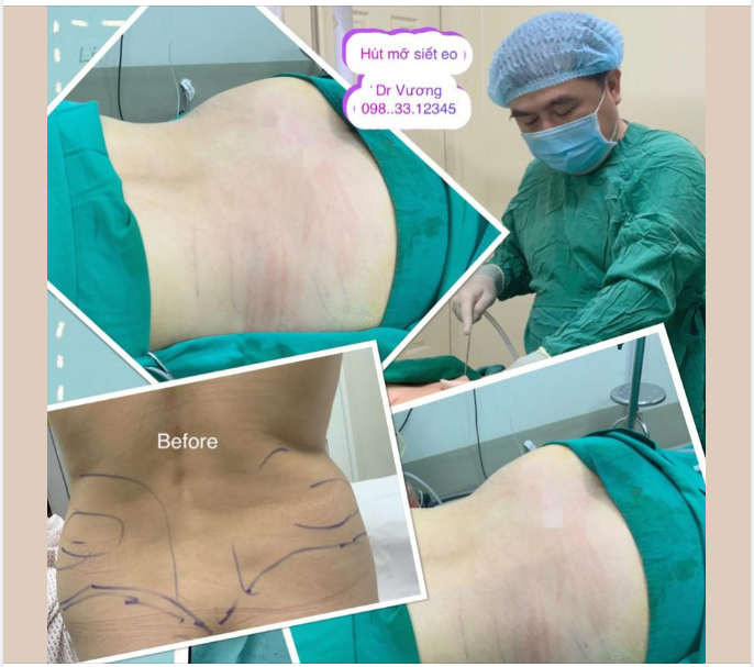 Hút mỡ siết eo với Dr Vương :