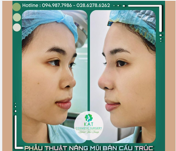 NÂNG MŨI CAO TẤY CHUẨN ĐẸP TỰ NHIÊN