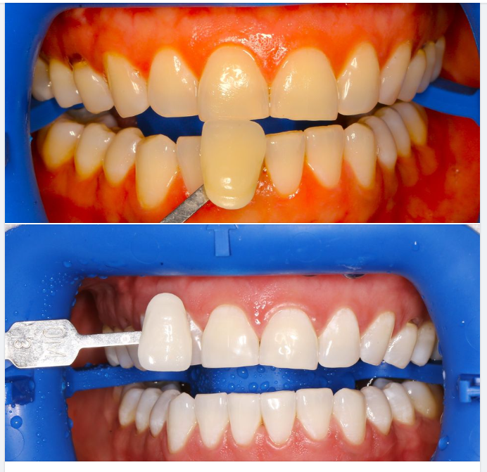  Một ca tẩy trắng răng bằng hệ thống Zoom, tại chi nhánh Sala, do bác sĩ Vũ điều trị!