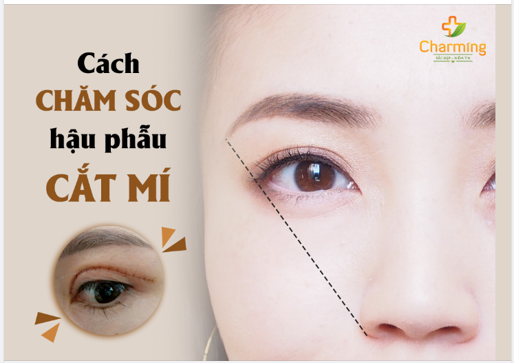 CHĂM SÓC HẬU PHẪU CẮT MÍ - CHUYỆN ĐƠN GIẢN NHƯ ĐANG GIỠN