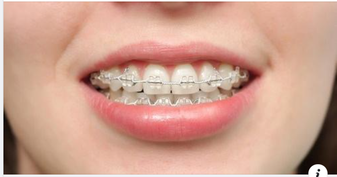 Niềng Răng Bằng Mắc Cài Sứ Có Tốt Không?