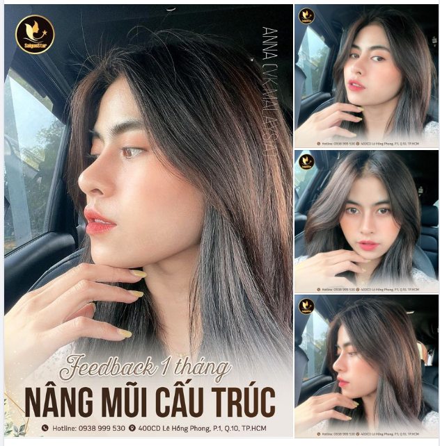 Feedback siêu phẩm dáng mũi sau 1 tháng của bạn khách Việt kiều Malaysia. Mũi chuẩn đẹp nâng tầm nhan sắc, thăng hạng tự tin, giúp gương mặt sang hơn nhiều lần.