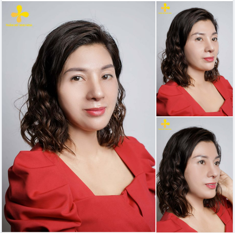 Chị Đinh Thu Trang - Combo Nâng mũi  Độn cằm trong ngày cắt chỉ.